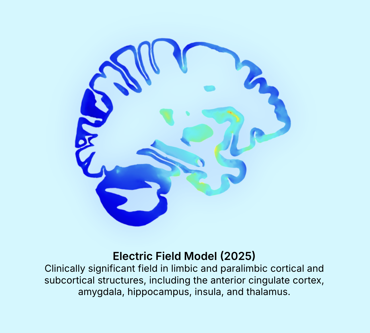 Electric Field Model (2025): clinically significant field in limbic and paralimbic cortical and subcortical structures, including the anterior cingulate cortex, amygdala, hippocampus, insula, and thalamus.